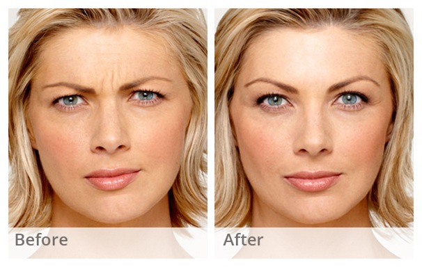 Botox treatment for frown lines wrinkles