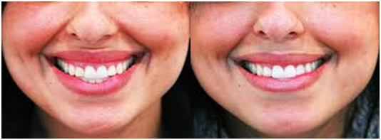 botox treatment for gummy smile