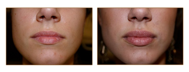 juvederm restylane for lip job lip enhancement