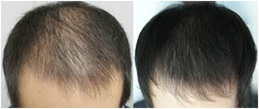 PRP platelet rich plasma treatment for hair loss,hair restoration jalandhar punjab India