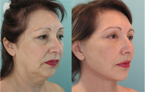 Thread facelift before and after procedure