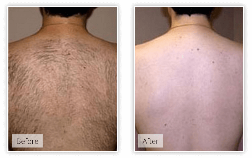 laser hair removal jalandhar punjab india at affordable cost