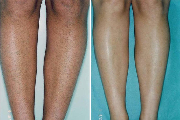 laser hair removal legs, thighs jalandhar punjab india