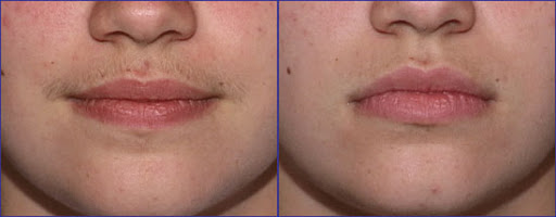 laser hair removal upper lip jalandhar punjab india