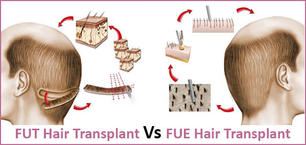Hair transplant surgery FUE - Harpreet Facial Aesthetic Centre for Face  Fillers, Facelift and Botox