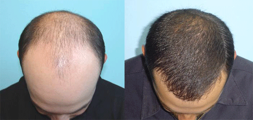 hair transplant surgery cost jalandhar punjab - Harpreet Facial Aesthetic  Centre for Face Fillers, Facelift and Botox